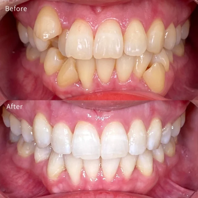 🦷 インビザラインで抜歯矯正を行い、正中のズレを改善したケースです 🦷

「歯並びを綺麗にしたい」というご相談でしたが、この方は前歯の叢生だけでなく、上下の正中にもズレがありました。
正中とは歯の中心線のことで、笑った時の印象や顔全体のバランスにも関わる重要なポイントです✨

このケースでは抜歯スペースを利用しながら歯を移動し、歯並びの改善だけでなく、正中を可能な限り合わせることを目標に治療を行いました。
ただし、ここで大切なのは、
「正中は必ずしも合わせられるわけではない」
ということです。

歯の本数の違い、親知らずの有無、骨格的な左右差、顎のズレなどによっては、歯だけを動かしても理想的な位置まで合わせることが難しい場合もあります。

そのため矯正治療では、
✅ 正中をどこまで改善できるのか ✅ 無理に合わせることで別の問題が出ないか ✅ 見た目と噛み合わせのバランスはどうか
を診断した上で治療計画を立てることが重要です。

マウスピース矯正は「目立たない矯正」というイメージがありますが、適切な診断と設計があれば、このような抜歯を伴う症例にも対応できます😊
単純に歯を並べるだけではなく、
✨ 正中 ✨ 口元のバランス ✨ 噛み合わせ ✨ 長期的な安定性
まで考えて治療を行っています。