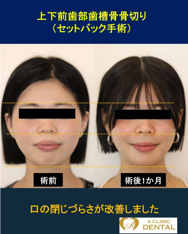 【口ゴボに対するセットバック手術】
20 歳、女性
主訴：出っ歯を治したい、口ゴボが気になる
治療内容：上下顎前歯部歯槽骨骨切り術（上下セットバック術）
リスク：腫れ、出血、痛み、感染、知覚のしびれなど
料金：HP をご参照ください

上あごの前歯が出っ歯状態にあり、骨格的にも上あごの前方位が認められました。一方で、臼歯の噛み合わせは問題なかったため、上下セットバック術を適用しました。上下セットバック術のみでは小臼歯抜歯部位の隙間を完全に埋めることは難しいため、歯科矯正治療を術後から開始するサージェリーファースト法を用いています。

サージェリーファースト法とは…
術前矯正を原則として行わず、先に顎の骨格を整えてから術後矯正を進める治療法です。
〈主なメリット〉
✓ 治療の早い段階で顔貌の変化を実感しやすい
✓ 術前矯正による一時的な見た目や噛み合わせの悪化を避けられる
✓ 症例によっては、全体の治療期間を短縮できる可能性がある

臼歯の噛み合わせが変わらずに、食事がとりやすいこともあり、術翌日には回転寿司へ行ったと伺ってます。術後 3 か月ほど経過しておりますが、矯正治療をすでに開始しており、顔貌・噛み合わせともに良好な結果が得られつつあります。恋人ができたという喜びも感じておられます。
＝＝＝＝＝＝＝＝＝＝＝＝＝＝＝＝＝＝＝＝＝＝＝＝＝＝
軽部健史（かるべたけし）
2010 年東北大学歯学部 首席卒業
慶應義塾大学病院、市中病院において口腔外科全般・顎矯正手術（骨切り）を研鑽
・日本口腔外科学会口腔外科認定医・専門医
・日本顎変形症学会認定医
・日本小児口腔外科学会認定医
・日本がん治療認定医機構 がん治療認定医（歯科口腔外科）
・日本有病者歯科医療学会認定専門医
・日本有病者歯科医療学会認定医
・日本口腔科学会認定医
＝＝＝＝＝＝＝＝＝＝＝＝＝＝＝＝＝＝＝＝＝＝＝＝＝＝
受診・無料カウンセリング
https://a-clinic.dental

#口ゴボ矯正 #口ゴボ #セットバック #セットバック手術 #小顔