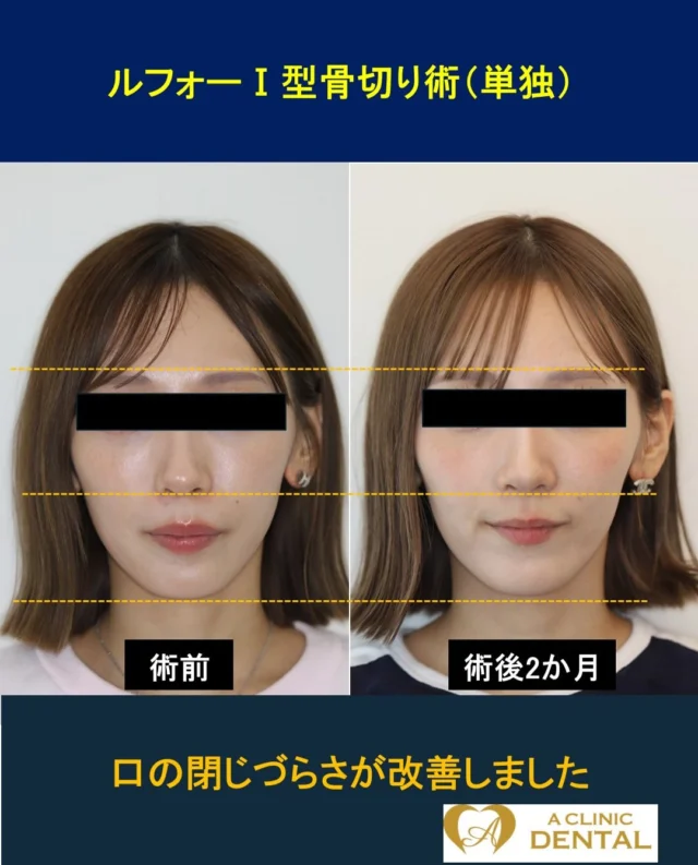 【小下顎かつ上顎前突症に対するルフォーⅠ型骨切り術（単独）】
27 歳、女性
主訴：上あごが出ている。下あごが小さいから出したほうが良いのか。
治療内容：ルフォーⅠ型骨切り術（単独）
リスク：腫れ、出血、痛み、感染、知覚のしびれ、固有鼻腔狭小化など
料金：HP をご参照ください
上あごが出ていること主訴にご来院されました。下あごを前に出すとちょうどよく見えるという自覚もあり、下あごを前に出すのが適応かという悩みでした。しかし、若年女性において、骨格性上顎前突症患者に対する下あごの骨切り術は術後の顎関節部の骨の吸収を起こすリスクが近年学会レベルで議論されています。これを進行性下顎頭吸収（PCR）といいます。そこで、そのリスクを低減するために、上あごのみの手術を行い、下顎は自然な反時計回転でかみ合わせを誘導させるという方法（オートローテーション）があります。そこで当患者様ではルフォーⅠ型骨切り術（単独）を適用し、術後は目立たないマウスピース矯正を用いて、オートローテーションをさせる方法を選択しました。
当方法のメリットとしては
・下あごを直接骨切りせずに、下あご・オトガイを前上方へ移動できる
・下あごの後退感や軽度の口ゴボ、下顔面高の長さを改善できる
・ガミースマイルと下あご後退感を同時に改善しやすい
・手術部位が上あごだけなので、一般に出血・腫脹・手術時間・術後負担を抑えやすい

術後 2 か月現在はマウスピース矯正を行っており、目立たないという心理的側面にも十分な配慮をしております。今後、さらに下あごが反時計回転することで、良好な E ラインへと導けることを確信しております。顔貌・噛み合わせともに良好な結果が得られつつあります。当患者様は手術に強い恐怖があったため、上あごが出ていることを悩まれていましたが、全身麻酔で眠る前に「先生！今より多少 上あごが前に出てもいいので、必ず生きて帰らせてください」と言われたことをよく覚えています。当然、現在も元気にお過ごしです。
＝＝＝＝＝＝＝＝＝＝＝＝＝＝＝＝＝＝＝＝＝＝＝＝＝＝
軽部健史（かるべたけし）
2010 年東北大学歯学部 首席卒業
慶應義塾大学病院、市中病院において口腔外科全般・顎矯正手術（骨切り）を研鑽
・日本口腔外科学会口腔外科認定医・専門医
・日本顎変形症学会認定医
・日本小児口腔外科学会認定医
・日本がん治療認定医機構 がん治療認定医（歯科口腔外科）
・日本有病者歯科医療学会認定専門医
・日本有病者歯科医療学会認定医
・日本口腔科学会認定医
＝＝＝＝＝＝＝＝＝＝＝＝＝＝＝＝＝＝＝＝＝＝＝＝＝＝
受診・無料カウンセリング
https://a-clinic.dental

#ルフォー #出っ歯 #骨切り #小顔 #矯正