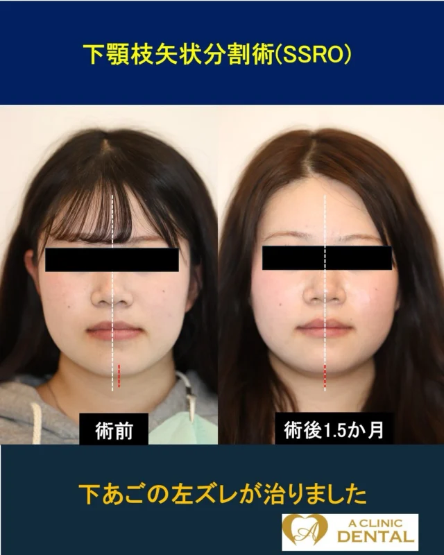 【下あご非対称と受け口に対する下顎枝矢状分割術（SSRO）】
19 歳、女性
主訴：下あごが出ていて、左にズレている。写真うつりが悪い。
治療内容：SSRO
リスク：腫れ、出血、痛み、感染、知覚のしびれなど
料金：HP をご参照ください

受け口と下あごのズレを主訴にご来院されました。成人式とその前撮りの前に、顔と噛み合わせをきれいにしたいというご希望でした。通常、保険適応の顎矯正手術（骨切り）を行
う場合、術前に 1.5 年程度の表側ワイヤーによる術前矯正治療が必要となります。この場合、ご本人の前撮り・式に間に合わせることはできないうえ、見えない矯正をご希望され
たため、サージェリーファースト法とマウスピース矯正治療の計画を立てました。
サージェリーファースト法とは…
術前矯正を原則として行わず、先に顎の骨格を整えてから術後矯正を進める治療法です。
〈主なメリット〉
✓ 治療の早い段階で顔貌の変化を実感しやすい
✓ 術前矯正による一時的な見た目や噛み合わせの悪化を避けられる
✓ 症例によっては、全体の治療期間を短縮できる可能性がある
術後 5 か月現在はマウスピース矯正を行っており、目立たないという心理的側面にも十分な配慮をしております。今後、さらに上の前歯が内側に入ることで、良好な E ラインへと
導けることを確信しております。顔貌・噛み合わせともに良好な結果が得られつつあります。今夏に前撮りが行われますが、素晴らしい写真となることと思います。
＝＝＝＝＝＝＝＝＝＝＝＝＝＝＝＝＝＝＝＝＝＝＝＝＝＝
軽部健史（かるべたけし）
2010 年東北大学歯学部 首席卒業
慶應義塾大学病院、市中病院において口腔外科全般・顎矯正手術（骨切り）を研鑽
・日本口腔外科学会口腔外科認定医・専門医
・日本顎変形症学会認定医
・日本小児口腔外科学会認定医
・日本がん治療認定医機構 がん治療認定医（歯科口腔外科）
・日本有病者歯科医療学会認定専門医
・日本有病者歯科医療学会認定医
・日本口腔科学会認定医
＝＝＝＝＝＝＝＝＝＝＝＝＝＝＝＝＝＝＝＝＝＝＝＝＝＝
受診・無料カウンセリング
https://a-clinic.dental

#受け口 #反対咬合 #SSRO #顔面非対称 #eline