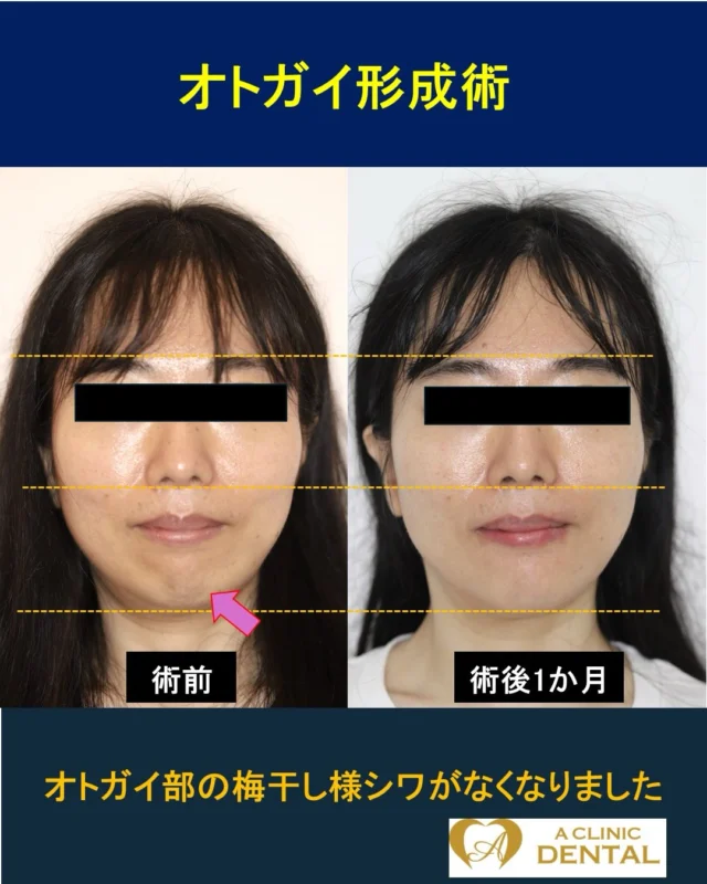 【オトガイの梅干し様シワ改善のためオトガイ形成術】
33 歳、女性
主訴：口が閉じづらい、オトガイのシワが気になる
治療内容：オトガイ形成術
リスク：腫れ、出血、痛み、感染、知覚のしびれなど
料金：HP をご参照ください

軽度ガミースマイルや上あご前突もありましたが、コストや外科的なリスクをなるべく低減したいというご希望もあり、オトガイ形成術のみの施行となりました。

ご本人は矯正治療を受けた経験はありましたが、依然口の閉じづらさは上あごの骨格的な前突とオトガイ後退にありました。オトガイ形成のダウンタイムは 2 週間程度あり、一時はあごが伸びたかのように腫れます。術後 1 か月の写真では腫れは改善し、正面から見たオトガイの梅干し様シワがなくなっているのがわかります。下唇周囲にわずかなしびれはありますが、半年から 1 年ほどで治癒する見込みです。
また、ご本人の希望もありオトガイ前方移動は 6~7mm にとどめ、日本人としてごく自然な E ラインの仕上がりとなることをポイントとしています。
＝＝＝＝＝＝＝＝＝＝＝＝＝＝＝＝＝＝＝＝＝＝＝＝＝＝
軽部健史（かるべたけし）
2010 年東北大学歯学部 首席卒業
慶應義塾大学病院、市中病院において口腔外科全般・顎矯正手術（骨切り）を研鑽
・日本口腔外科学会口腔外科認定医・専門医
・日本顎変形症学会認定医
・日本小児口腔外科学会認定医
・日本がん治療認定医機構 がん治療認定医（歯科口腔外科）
・日本有病者歯科医療学会認定専門医
・日本有病者歯科医療学会認定医
・日本口腔科学会認定医
＝＝＝＝＝＝＝＝＝＝＝＝＝＝＝＝＝＝＝＝＝＝＝＝＝＝
受診・無料カウンセリング
https://a-clinic.dental

#オトガイ形成 #オトガイ後退 #eライン #eline #横顔美人