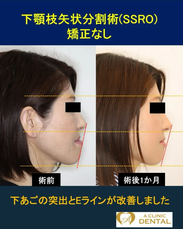 【多数歯欠損の受け口患者に対する下顎枝矢状分割術（SSRO）】
49 歳、女性
主訴：受け口を治したい。
治療内容：SSRO
リスク：腫れ、出血、痛み、感染、知覚のしびれなど
料金：HP をご参照ください

受け口の改善を主訴にご来院されました。昔、矯正治療経験があったが、自己都合によりドロップアウトした経験がありました。一方で、虫歯や歯周病のために多くの歯を失って
きました。ずっと受け口に悩んでおり、手術に踏み切る勇気はなかったのですが、当院のHP や SNS を見て、意を決することができたようです。今回は SSRO のみにとどめて、の
ちにンプラントなどを用いた噛み合わせの構築を考えていく予定です。つまり、下あごを後方に移動した際に現状で最も安定する噛み合わせに設定して手術を行いました。理想を
言えば、もう少し後方に移動できるとより下あごの突出感を改善できますが、これが本症例での限界となります。安定しない咬合は術後の早期後戻りへ導きます。歯科医が行う、
骨切りの勘所はこういった点にあります。また、術中に適度な噛み合わせ調整も加えて行っております。
術後 1 か月現在 咬合は安定し、経過良好です。今後は入れ歯も含めて噛み合わせ構築を早期に行っていく予定です。
＝＝＝＝＝＝＝＝＝＝＝＝＝＝＝＝＝＝＝＝＝＝＝＝＝＝＝
軽部健史（かるべたけし）
2010 年東北大学歯学部 首席卒業
慶應義塾大学病院、市中病院において口腔外科全般・顎矯正手術（骨切り）を研鑽・日本口腔外科学会口腔外科認定医・専門医
・日本顎変形症学会認定医
・日本小児口腔外科学会認定医
・日本がん治療認定医機構 がん治療認定医（歯科口腔外科）
・日本有病者歯科医療学会認定専門医
・日本有病者歯科医療学会認定医
・日本口腔科学会認定医
＝＝＝＝＝＝＝＝＝＝＝＝＝＝＝＝＝＝＝＝＝＝＝＝＝＝＝
受診・無料カウンセリング
https://a-clinic.dental

#受け口 #反対咬合 #SSRO #後戻り #eline