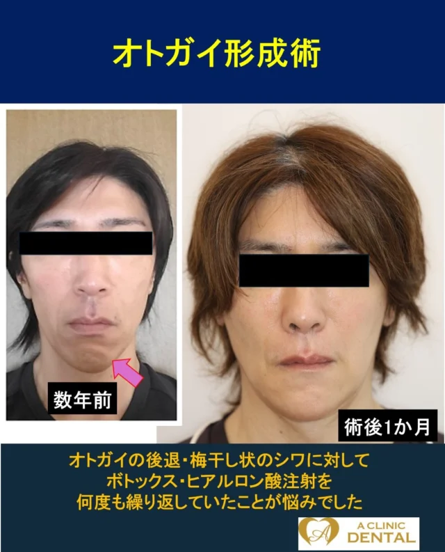 【ボトックス・ヒアルロン酸注射から解放される、永続的なオトガイ形成術】
52 歳、男性
主訴：オトガイのシワと後退が気になる
治療内容：オトガイ形成術
リスク：腫れ、出血、痛み、感染、知覚のしびれなど
料金：HP をご参照ください

昔から、オトガイ部の後退・梅干し状シワに悩まれていました。そのため、長年筋肉の緊張を緩めるためのボトックス注射と膨らみを出すためのヒアルロン酸注射を行ってきました。しかし、そのかさむ費用と注射の効能が切れた後の後戻りを考慮して、当院でのオトガイ形成術を決意されました。

あまり変化がないように思われるかもしれませんが、その微々たる変化にご本人が最もよく理解しており、満足されているようです。
術後 1 か月の写真では腫れは改善し、正面から見たオトガイの梅干し様シワがなくなっているのがわかります。下唇周囲にわずかなしびれはありますが、半年から 1 年ほどで治癒
する見込みです。術後からはボトックス・ヒアルロン酸注射から解放され、非常に快適に過ごされているようです。
また、日本人としてごく自然な E ラインの仕上がりとなることをポイントとしています。
＝＝＝＝＝＝＝＝＝＝＝＝＝＝＝＝＝＝＝＝＝＝＝＝＝＝
軽部健史（かるべたけし）
2010 年東北大学歯学部 首席卒業
慶應義塾大学病院、市中病院において口腔外科全般・顎矯正手術（骨切り）を研鑽
・日本口腔外科学会口腔外科認定医・専門医
・日本顎変形症学会認定医
・日本小児口腔外科学会認定医
・日本がん治療認定医機構 がん治療認定医（歯科口腔外科）
・日本有病者歯科医療学会認定専門医
・日本有病者歯科医療学会認定医
・日本口腔科学会認定医
＝＝＝＝＝＝＝＝＝＝＝＝＝＝＝＝＝＝＝＝＝＝＝＝＝＝
受診・無料カウンセリング
https://a-clinic.dental

#オトガイ形成 #オトガイ後退 #梅干しじわ #ボトックス #ヒアルロン酸注射