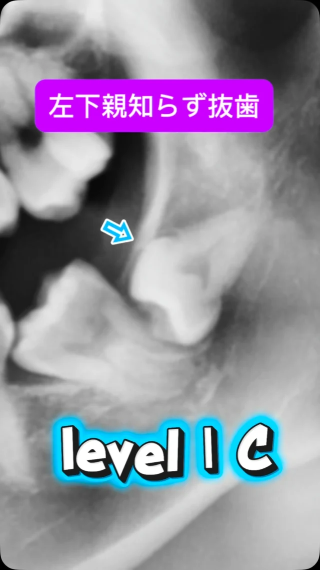 難易度高めの左下親知らず抜歯🦷

歯ぐきを切り開いたあと、宝探しのように適切に骨を削って歯の頭を見つけます🤭
引っかかる頭を丁寧に分割して、抜去します。
少し時間かかってしまいました🙇‍♂️

ま、なんでも抜けますので😊

（比較的）短時間で安全かつ痛くなく、完遂できます。

#親知らず抜歯 #口腔外科　#口腔外科専門医 #痛くない抜歯 #東京口腔外科