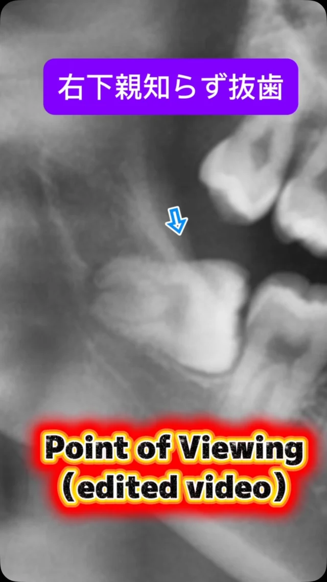 臨場感のある内容を🦷
右下親知らず抜歯。

POV camera（視点カメラ）の映像もふまえて（わかりやすいように編集を加えてます）

ポイントをかいつまんで、こんな雰囲気で抜歯をします。
比較的簡単なケースでもあるため切開から縫合完了まで4分で行えます。

なんでもお手のもの😊

短時間で安全かつ痛くなく、完遂できます。

#親知らず抜歯 #口腔外科　#口腔外科専門医 #痛くない抜歯 #東京口腔外科