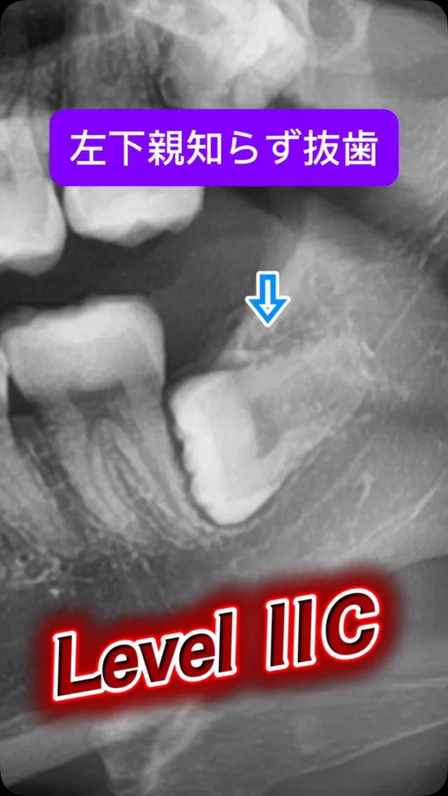 臨場感のある内容を🦷
左下親知らず抜歯。

POV camera（視点カメラ）の映像もふまえて（わかりやすいように編集を加えてます）

ポイントをかいつまんで、こんな雰囲気で抜歯をします。
比較的難しいケースでもあったため切開から縫合完了ま約12分でした。

なんでもお手のもの😊

短時間で安全かつ痛くなく、完遂できます。

#親知らず抜歯 #口腔外科　#口腔外科専門医 #痛くない抜歯 #東京口腔外科