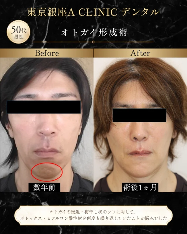 【繰り返すボトックス・ヒアルロン酸注射から、オトガイ形成術という選択肢へ】

52歳・男性の患者様。
「顎先の後退と梅干し様のシワが気になる」
というお悩みでご相談いただきました。

― CASE ―
■ 主訴
オトガイの後退、梅干し様シワ

■ 治療内容
オトガイ形成術

今回の患者様は、以前からオトガイの後退と、口を閉じたときに現れる梅干し様のシワに悩まれていました。

そのため、これまで筋肉の緊張を和らげるボトックス注射や、顎先にボリュームを補うヒアルロン酸注射を継続されていました。

しかし、定期的な施術が必要になることや、その都度費用がかかることから、別の治療方法を検討され、当院へご相談いただきました。

【治療設計のポイント】
ボトックスやヒアルロン酸注射は、筋肉の緊張を和らげたり、顎先の形を補ったりする治療方法の一つです。

一方で、今回の患者様はオトガイの骨格的な後退が認められました。

そこで、注入治療を繰り返すのではなく、顎先の骨そのものを移動させる「オトガイ形成術」を選択しました。

オトガイ形成術では、単に顎先を大きく前へ出すことを目的とするのではありません。

鼻・口元・顎先の位置関係を確認しながら、その方の顔貌に馴染む自然なEラインを目指して移動量を検討することが大切です。

■ オトガイ形成術とは
オトガイ形成術は、顎先の骨を移動させることで、おとがいの位置や形態を整える治療です。

症例によっては、
・オトガイの後退感
・梅干し様シワ
・口元の突出感
・横顔のバランス
・Eライン
などを総合的に考えた際の治療選択肢となります。

注入によって形を補う方法とは異なり、骨格そのものにアプローチできる点が特徴です。

【術後の経過】
現在は術後約1か月。

腫れは徐々に落ち着き、正面から見た際のオトガイの梅干し様シワも目立ちにくくなっています。

大きな変化ではないように見える場合でも、数mm単位の顎先の位置の変化によって、正面・横顔の印象が変わることがあります。

また、術後は下唇周囲にわずかなしびれが残っていますが、引き続き経過を確認しています。

現在はボトックスやヒアルロン酸注射を行わずに過ごされており、ご本人にも変化を実感していただいています。

横顔を整える治療では、
「顎先をどれだけ前に出すか」
だけで決まるものではありません。

鼻・口唇・オトガイまで含めて顔貌全体を診断し、
「どこを動かすことで自然なバランスになるのか」
を考えることが重要です。

大きく変えるのではなく、自然に整える。
当院では、一人ひとりの骨格やお悩みに合わせて治療計画をご提案しています。

※治療結果や術後の経過には個人差があります。

────────────────

■ リスク・副作用
腫れ、出血、痛み、感染、知覚のしびれなどが生じる可能性があります。

■ 料金
治療内容・費用の詳細は公式HPをご確認ください。

────────────────

【担当医】
軽部 健史（かるべ たけし）

2010年 東北大学歯学部 首席卒業
慶應義塾大学病院・市中病院にて、口腔外科全般および顎矯正手術（骨切り）を研鑽

・日本口腔外科学会 口腔外科認定医・専門医
・日本顎変形症学会 認定医
・日本小児口腔外科学会 認定医
・日本がん治療認定医機構 がん治療認定医（歯科口腔外科）
・日本有病者歯科医療学会 認定専門医
・日本有病者歯科医療学会 認定医
・日本口腔科学会 認定医

────────────────

「顎先の後退が気になる」
「口を閉じると梅干し様のシワができる」
「注入治療以外の方法も知りたい」
そのようなお悩みも、まずはご相談ください。

受診・無料カウンセリングは
プロフィールの公式HPよりご確認いただけます。

#オトガイ形成 #オトガイ形成術 #オトガイ後退 #梅干しじわ #Eライン #横顔 #ボトックス #ヒアルロン酸注射 #顎形成 #骨切り #東京銀座ACLINICデンタル #ダウンタイム