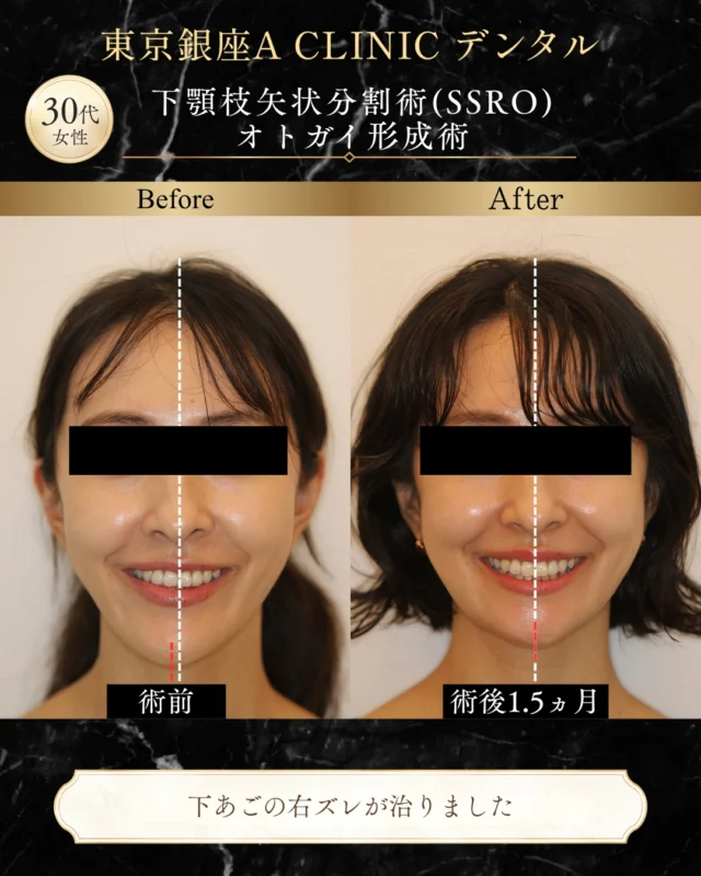 【顎のズレと開咬に対するサージェリーファースト法】

32歳・女性の患者様。
「顎のズレと開咬を治したい」
というお悩みでご相談いただきました。

― CASE ―
■ 主訴
顎のズレ、軽度開咬

■ 治療内容
下顎枝矢状分割術（SSRO）
オトガイ形成術

今回の患者様は、過去にワイヤー矯正治療を受けた経験があり、もともと反対咬合気味だったとのことです。

矯正治療によって歯並びは整いましたが、その後徐々に顎のズレ感と開咬がみられるようになっていました。

診察の結果、歯並びだけではなく骨格的な要素も大きく、矯正治療のみで顔貌と噛み合わせの両方を整えることは難しいと判断しました。

そこで今回は、サージェリーファースト法を用いた顎矯正手術と、術後のマウスピース矯正を組み合わせた治療計画としました。

【治療設計のポイント】
患者様はこれまで複数の医院でカウンセリングを受けており、当院のHPをご覧いただいたことをきっかけにご来院されました。

診察やカウンセリングを重ねながら、骨格・噛み合わせ・顔貌について一つひとつ確認し、治療方針を決定しました。

今回の症例では、下顎のズレと開咬に対してSSROを行うだけでなく、オトガイ形成術も併用しています。

手術前にはシミュレーションを行い、
「顎の骨をどの方向へ、どの程度動かすのか」
「オトガイ形成を加えることで横顔や正面の印象がどのように変化するのか」
を視覚的に確認していただきながら、患者様のご希望も踏まえて治療計画を立てました。

■ サージェリーファースト法とは
サージェリーファースト法は、原則として術前矯正を行わず、先に顎の骨格を整え、その後に矯正治療を進めていく方法です。

症例によっては、
・治療の早い段階で顔貌の変化を実感しやすい
・術前矯正による一時的な見た目や噛み合わせの変化を避けやすい
・治療期間を短縮できる可能性がある
などの特徴があります。

一方で、すべての症例に適応できる治療方法ではありません。

骨格・歯並び・噛み合わせを詳しく確認し、手術後の矯正治療まで見据えて適応を判断することが大切です。

【術後の経過】
現在は術後約1.5か月。

術後1か月頃には、日常生活への影響も徐々に少なくなり、現在はマウスピース矯正を進めています。

顎のズレや開咬についても変化がみられており、今後は歯並びと噛み合わせをさらに細かく整えていきます。

また、術後の経過の中で骨のわずかな突出など気になる部分が残る場合には、プレート除去の際に調整を検討できることもお伝えしています。

現時点では自然な回復を確認しながら、引き続き経過をみていきます。

顎矯正治療では、
「歯並びが整っている＝骨格や噛み合わせにも問題がない」
とは限りません。

過去に矯正治療を受けていても、骨格的なズレや開咬が残っている場合には、外科治療を含めた別のアプローチが選択肢となることがあります。

歯並びだけでなく、骨格・噛み合わせ・顔貌まで。
当院では、それぞれの状態を総合的に診断し、一人ひとりに合わせた治療計画をご提案しています。

※治療結果や術後の経過には個人差があります。

────────────────

■ リスク・副作用
腫れ、出血、痛み、感染、知覚のしびれなどが生じる可能性があります。

■ 料金
治療内容・費用の詳細は公式HPをご確認ください。

────────────────

【担当医】
軽部 健史（かるべ たけし）

2010年 東北大学歯学部 首席卒業
慶應義塾大学病院・市中病院にて、口腔外科全般および顎矯正手術（骨切り）を研鑽

・日本口腔外科学会 口腔外科認定医・専門医
・日本顎変形症学会 認定医
・日本小児口腔外科学会 認定医
・日本がん治療認定医機構 がん治療認定医（歯科口腔外科）
・日本有病者歯科医療学会 認定専門医
・日本有病者歯科医療学会 認定医
・日本口腔科学会 認定医

────────────────

「顎のズレが気になる」
「前歯が噛み合わない」
「過去に矯正したけれど、骨格から相談したい」
そのようなお悩みも、まずはご相談ください。

受診・無料カウンセリングは
プロフィールの公式HPよりご確認いただけます。

#骨切り #サージェリーファースト #SSRO #下顎枝矢状分割術 #オトガイ形成 #開咬 #顎のズレ #顎矯正手術 #マウスピース矯正 #東京銀座ACLINICデンタル #ダウンタイム