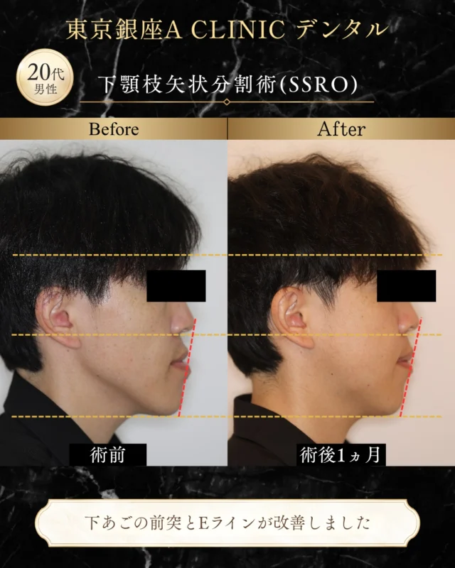 【骨格性下顎前突症に対するSSRO】

29歳・男性の患者様。
「昔から悩んでいる受け口を治したい」
というお悩みでご相談いただきました。

― CASE ―
■ 主訴
受け口

■ 治療内容
下顎枝矢状分割術（SSRO）

今回の患者様は、以前から受け口に悩まれており、長年、骨切り手術を受けるか迷われていました。
当院のYouTubeをご覧いただいたことをきっかけにご来院され、カウンセリングを重ねながら治療方針を検討しました。

診察の結果、歯の位置だけではなく、骨格的に下顎が前方へ突出している状態が認められたため、下顎枝矢状分割術（SSRO）を行うこととなりました。

【治療設計のポイント】
術前シミュレーションでは、SSROに加えてオトガイ形成術を併用することも治療選択肢の一つとして検討しました。

一方で患者様からは、
「男性らしい、しっかりとした顎の印象は残したい」
というご希望がありました。

そこで今回は、オトガイの形態を大きく変えず、SSROのみで下顎の位置を整える治療計画としました。

顎矯正手術では、シミュレーション上で考えられる治療をすべて行うことが、必ずしもその方にとって望ましいとは限りません。

骨格や噛み合わせだけでなく、
「どのような顔貌を希望されているのか」
まで確認しながら、治療範囲を決めることが大切です。

今後、プレート除去を行う際には、その時点での顔貌やご希望を確認したうえで、必要に応じてオトガイ形成術を検討することも可能です。

■ SSROとは
SSRO（下顎枝矢状分割術）は、下顎の骨を左右で分割し、下顎全体を前後または左右へ移動させる顎矯正手術です。

症例によっては、
・受け口
・下顎の突出感
・下顎の左右差
・噛み合わせのずれ
などを改善するための治療選択肢となります。

単に下顎を後方へ移動するのではなく、噛み合わせや顔貌とのバランスを確認しながら、移動方向や移動量を検討します。

【術後の経過】
術後は下顎の位置に変化がみられ、現在も経過を確認しながら治療を進めています。

今回の患者様にはすきっ歯も認められたため、当初は術後にワイヤー矯正を行う予定でした。

その後、術後の顔貌の変化も踏まえ、
「できるだけ目立たない方法で矯正治療を進めたい」
というご希望があり、現在はマウスピース矯正へ治療方針を変更しています。

今後も歯並びと噛み合わせを細かく調整しながら、治療を進めていきます。

顎矯正治療では、
「受け口だから下顎を下げる」
だけではありません。

骨格・噛み合わせ・歯並びに加えて、その方が希望する顔貌まで確認し、
「どこまで、どのように変えるのか」
を考えることが重要です。

歯並びだけでなく、骨格・噛み合わせ・顔貌まで。
当院では、一人ひとりのお悩みやご希望に合わせて治療計画をご提案しています。

※治療結果や術後の経過には個人差があります。

────────────────

■ リスク・副作用
腫れ、出血、痛み、感染、知覚のしびれなどが生じる可能性があります。

■ 料金
治療内容・費用の詳細は公式HPをご確認ください。

────────────────

【担当医】
軽部 健史（かるべ たけし）

2010年 東北大学歯学部 首席卒業
慶應義塾大学病院・市中病院にて、口腔外科全般および顎矯正手術（骨切り）を研鑽

・日本口腔外科学会 口腔外科認定医・専門医
・日本顎変形症学会 認定医
・日本小児口腔外科学会 認定医
・日本がん治療認定医機構 がん治療認定医（歯科口腔外科）
・日本有病者歯科医療学会 認定専門医
・日本有病者歯科医療学会 認定医
・日本口腔科学会 認定医

────────────────

「昔から受け口に悩んでいる」
「骨切り手術について詳しく知りたい」
「顔の印象を変えすぎずに治療したい」
そのようなお悩みも、まずはご相談ください。

受診・無料カウンセリングは
プロフィールの公式HPよりご確認いただけます。

#受け口 #反対咬合 #SSRO #下顎枝矢状分割術 #オトガイ形成 #顎矯正手術 #骨切り #マウスピース矯正 #Eライン #東京銀座ACLINICデンタル #ダウンタイム