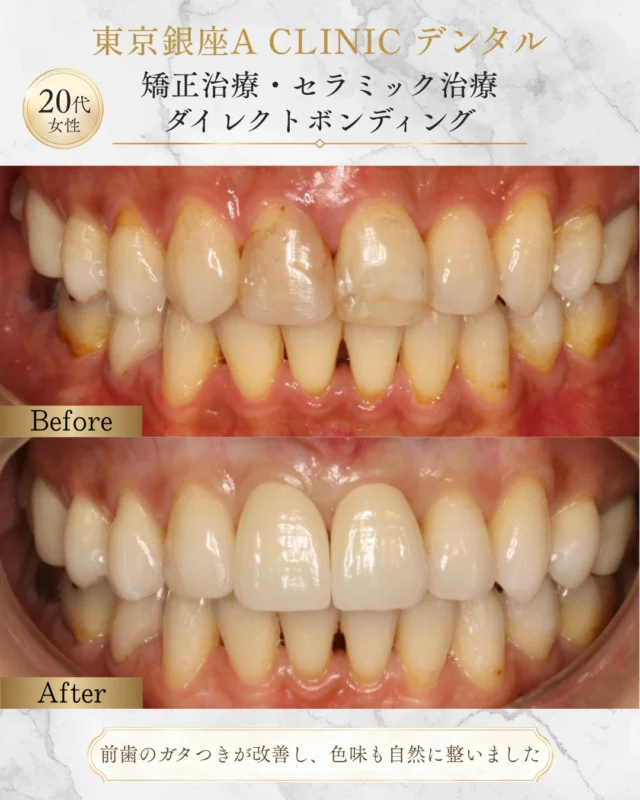 【前歯の欠損部を自然に回復した症例✨】

右上2番が欠損していた患者様です。
矯正治療によって歯列を整えた後、前歯のバランスを細かく調整しました🦷

今回行った処置は
▪️右上1番・左上1番 ✨セラミッククラウンにて形態と色調を調整
▪️右上3番 ✨本来の2番の役割を担うため、犬歯特有の尖りを減らすカンタリングを実施
▪️右上4番 ✨ダイレクトボンディングにより、3番のような自然な形態へ修正

単に歯を並べるだけではなく、
「どの歯を、どの歯に見せるか」
まで設計することで、欠損があることを感じさせない自然な前歯を目指しました😊

歯科治療は、 ただ歯を治すだけではありません。
お顔との調和や笑った時の印象、噛み合わせまで含めて設計することで、より自然で美しい仕上がりになります✨
審美性だけでなく、機能性と長期安定性も考慮しながら治療を行っています。

━━━━━━━━━━━━━━━
🦷 矯正治療 🦷 セラミック治療 🦷 ダイレクトボンディング
それぞれを組み合わせることで、より自然なスマイルを実現できる場合があります✨
━━━━━━━━━━━━━━━