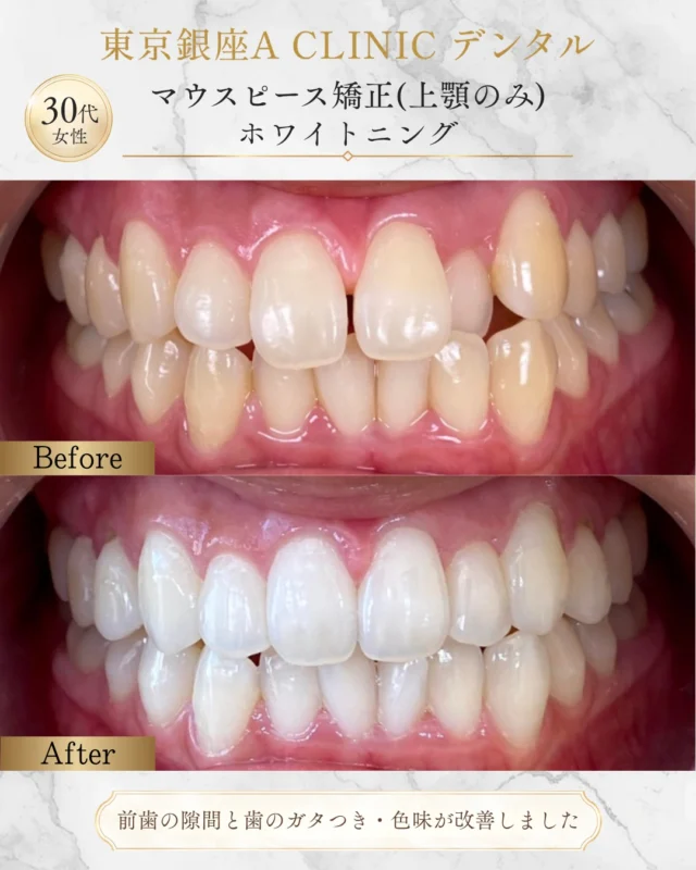 🦷✨ 上顎のみマウスピース矯正＋ホワイトニング症例 ✨🦷

「前歯の隙間（正中離開）が気になる」 「ワイヤー矯正は目立つから避けたい」
そんなご希望でご来院された患者様です。
今回は上顎のみのマウスピース矯正で正中離開を改善し、仕上げにホワイトニングを行いました✨

前歯の隙間が閉じるだけでも印象は大きく変わりますが、ホワイトニングを併用することで口元全体の清潔感もアップ😊

正中離開は比較的マウスピース矯正で改善しやすいケースも多く、 「できるだけ目立たず治療したい」 という方に適した選択肢の一つです。

ただし、隙間ができた原因によっては後戻りしやすいこともあるため、診断と保定が非常に重要になります☝️
当院では見た目の改善だけでなく、長期的な安定性も考慮して治療計画を立案しています。

📍治療内容 ・上顎マウスピース矯正 ・ホワイトニング

📍主訴 ・前歯の隙間（正中離開）が気になる

📍リスク・副作用 ・後戻り ・歯根吸収 ・アタッチメント脱離 ・ホワイトニングによる一時的な知覚過敏