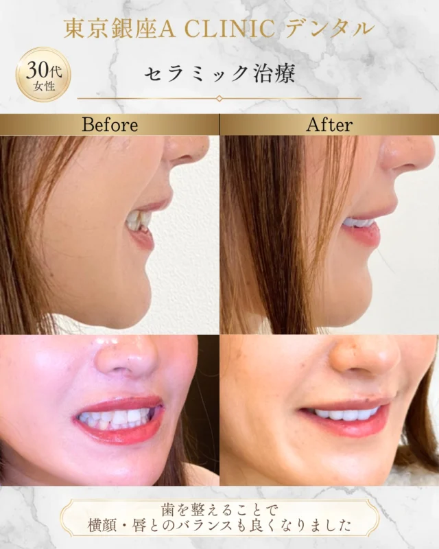 ✨【“元々綺麗”を、さらに洗練させる審美治療】✨

「歯並びがすごく悪いわけではない」
でも 
✔ 笑った時の見え方 ✔ 前歯の形 ✔ 口元のバランス 
こういった“少しの違和感”で お顔の印象は意外と変わります。

今回のケースも 大きく歯並びを変えたというより 👉 スマイルライン 👉 歯の見え方 👉 口元の清潔感 を整えることで、 より自然で上品な印象へ仕上げています🦷

審美治療は ただ白くするだけでも、 並べるだけでもありません。

その方の ✔ 顔立ち ✔ 横顔 ✔ 唇とのバランス まで含めて設計することで、 「なんか綺麗になった」 という自然な変化になります。

“元々綺麗な人ほど、細部で差が出る” これは審美治療でよく感じる部分です。

不自然に作り込まず、 その人らしい美しさを大切にしています✨
セラミック治療をご検討の方はご相談ください。