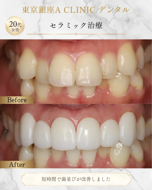 🦷【セラミック矯正は“悪”なのか？】

最近よく見ますよね 「セラミック矯正＝危険」という投稿⚠️

結論から言うと 👉 適応を間違えれば、確かに問題になります 👉 ただし、患者さんの要望によっては選択肢の一つです

今回のケースは

✔ とにかく短期間で改善したい ✔ 矯正は受け入れられない ✔ 自分の歯より白くしたい
という明確な希望がありました

つまり  「時間」と「方法」に強い制約があるケースです⏱️

本来の第一選択は
・矯正で歯列を整える ・ホワイトニングで色調改善

これが最も歯を守るアプローチです🛡️

ただし今回は 👉 患者側がそのルートを選択しない
この時に重要なのは「やらない」か「代替案を設計する」か

今回は
✔ 前突感のコントロール ✔ 形態・色調の最適化
を前提にセラミックで設計しています🧩

（写真では分かりにくいですが 口元の突出感は改善しています）

ここで誤解してほしくないのは
セラミック矯正は第一選択ではない
ただし、すべて否定するものでもない
ということ

重要なのは
「何をやるか」ではなく  「どう設計するか」
そして  「その選択を誰が、なぜ決めたのか」

審美治療は 単なる見た目の改善ではなく
人生の優先順位に対する医療介入です

だからこそ 複数の選択肢を提示した上で設計する
それが医療側の役割だと考えています

審美も、機能も、長期も すべてを踏まえて設計したい方はご相談ください🦷