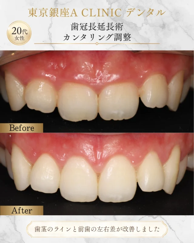 🦷【歯冠長延長術＋カンタリング調整で、自然なスマイルへ】

「歯が小さく見える」 「笑うと歯ぐきが気になる」 「なんとなく左右差が気になる」

実はその原因、 👉 歯ぐきのライン 👉 歯の見える長さ 👉 前歯の傾き（カント） が関係していることも少なくありません。

今回の症例では ✔ 歯冠長延長術 ✔ 歯肉ラインの調整 ✔ カンタリング（前歯の傾き補正） を行い、スマイル時のバランスを整えています✨

歯ぐきをただ切るだけでは ❌ 不自然に長く見える ❌ 左右差が残る ❌ 後戻りする こともあります。

さらに、 “歯だけ真っ直ぐ”でも 顔貌との調和が取れていないと 違和感のある口元になります。

そのため当院では 🪥 骨の位置 🪥 生物学的幅径 🪥 スマイルライン 🪥 顔貌とのバランス まで含めて設計しています。

審美治療は単に白くする治療ではなく、 👉 「違和感を減らす設計」 だと考えています。
少しのラインの差でも、 お顔全体の印象は変わります。
自然に整えたい方はご相談ください🌿