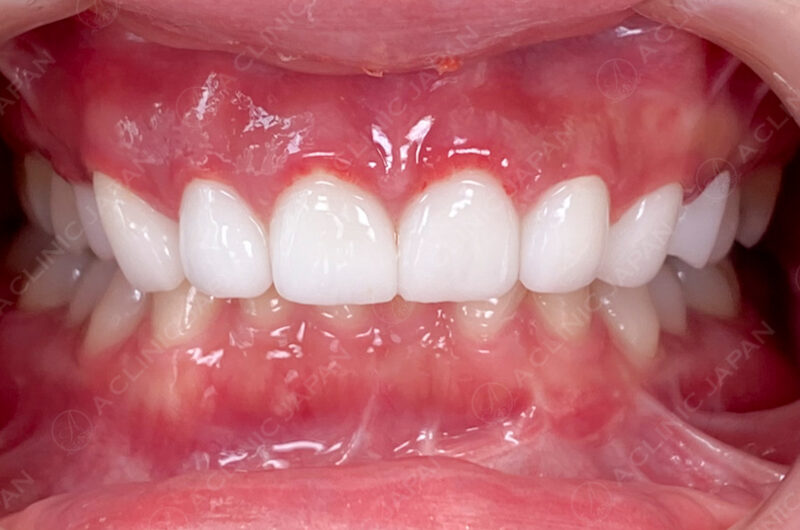 歯肉形成 症例写真 AFTER