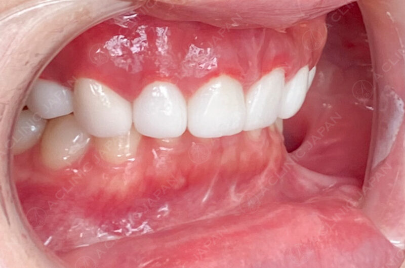 歯肉形成 症例写真 AFTER