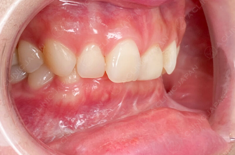 歯肉形成 症例写真 BEFORE